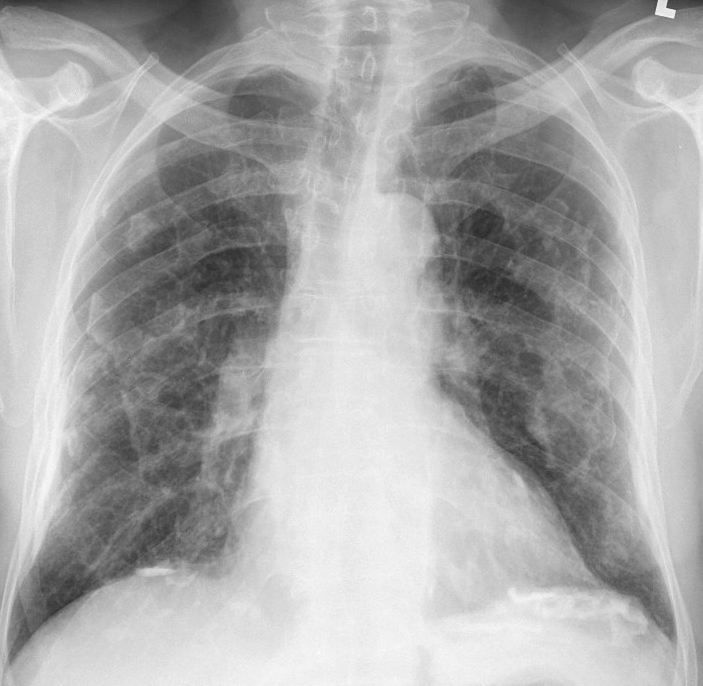 Fibroza pulmonară