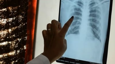 Un nou tip de pneumonie a fost depistat in China: 11 bolnavi sunt in stare foarte grava
