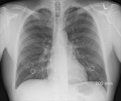 cancer pulmonar